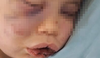 Darp Edilen Bebeğin Hayati Tehlikesi Sürüyor