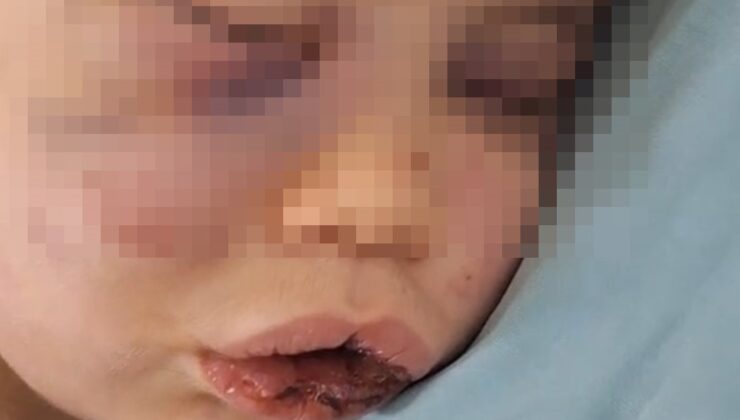 Darp Edilen Bebeğin Hayati Tehlikesi Sürüyor