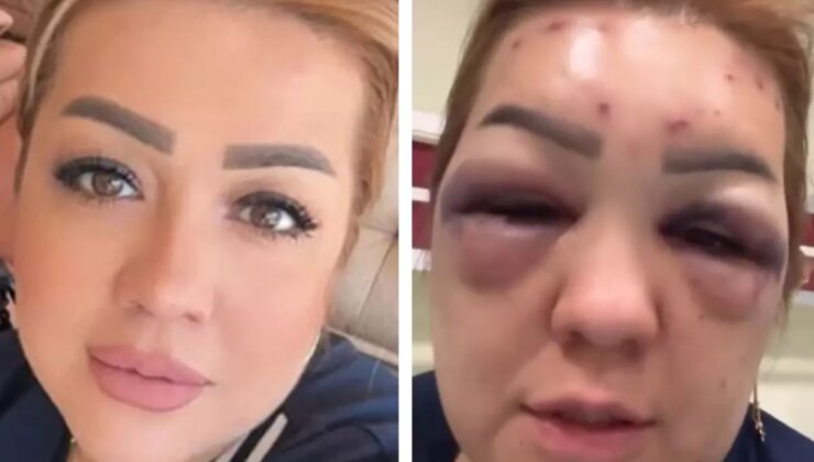 Yüzündeki Şişliklerin Sebebini Açıkladı