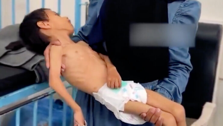 Gazze’de bir çocuk daha yetersiz beslenme nedeniyle yaşam savaşı veriyor