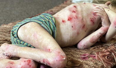 Gazze’de çocuklar hem açlık hem de hastalıkla mücadele ediyor