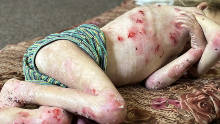 Gazze’de çocuklar hem açlık hem de hastalıkla mücadele ediyor