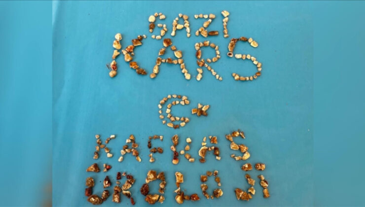 Kars’ta hastanın iki böbreğinden 300’ün üzerinde taş çıktı