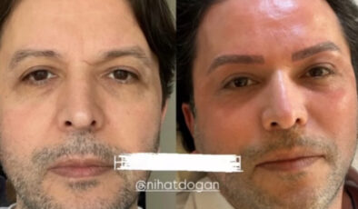 Nihat Doğan estetik işlem yaptırdı