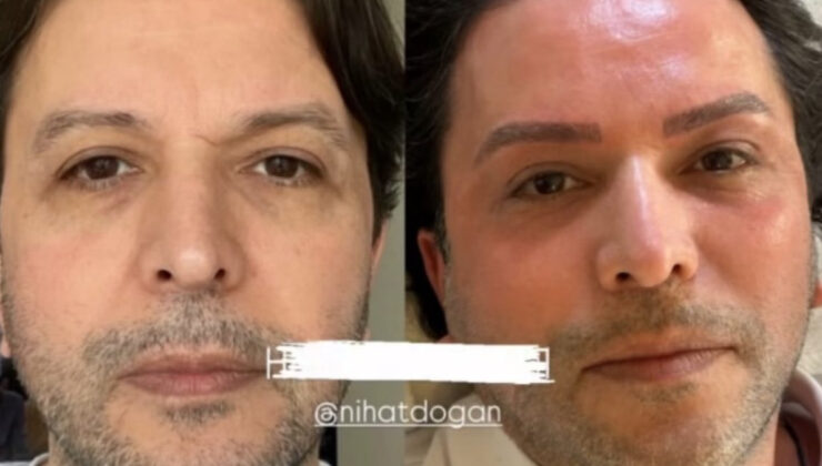 Nihat Doğan estetik işlem yaptırdı