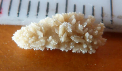 Böbrek taşlarının yeni düşmanı: Manyetik eritme robotu