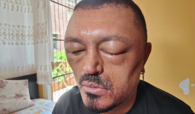 Saç Boyama Şampuanı Kabusu: Yüzü Şişti, Yaralar Çıktı