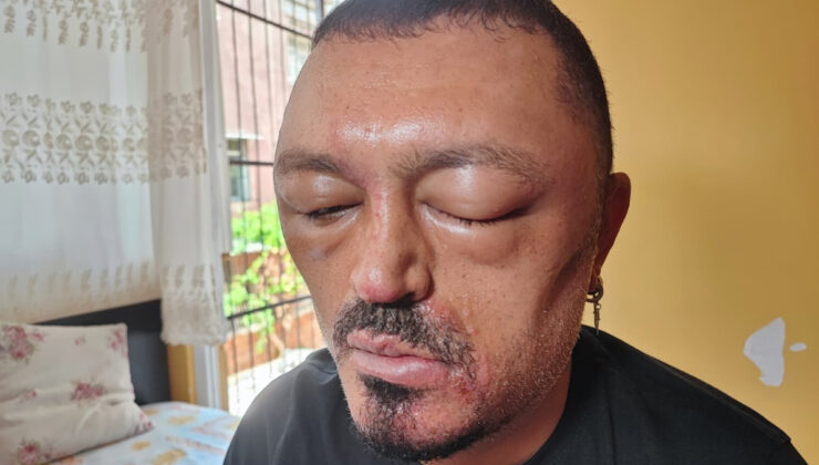 Saç Boyama Şampuanı Kabusu: Yüzü Şişti, Yaralar Çıktı