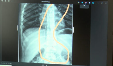 Şırnak’ta salatalık yutunca rahatsızlandı: 3 yıl önce vücudunda kateter unutulduğu belirlendi