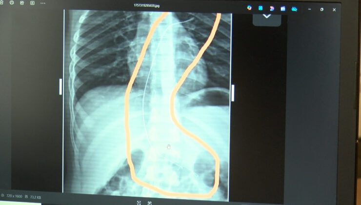 Şırnak’ta salatalık yutunca rahatsızlandı: 3 yıl önce vücudunda kateter unutulduğu belirlendi