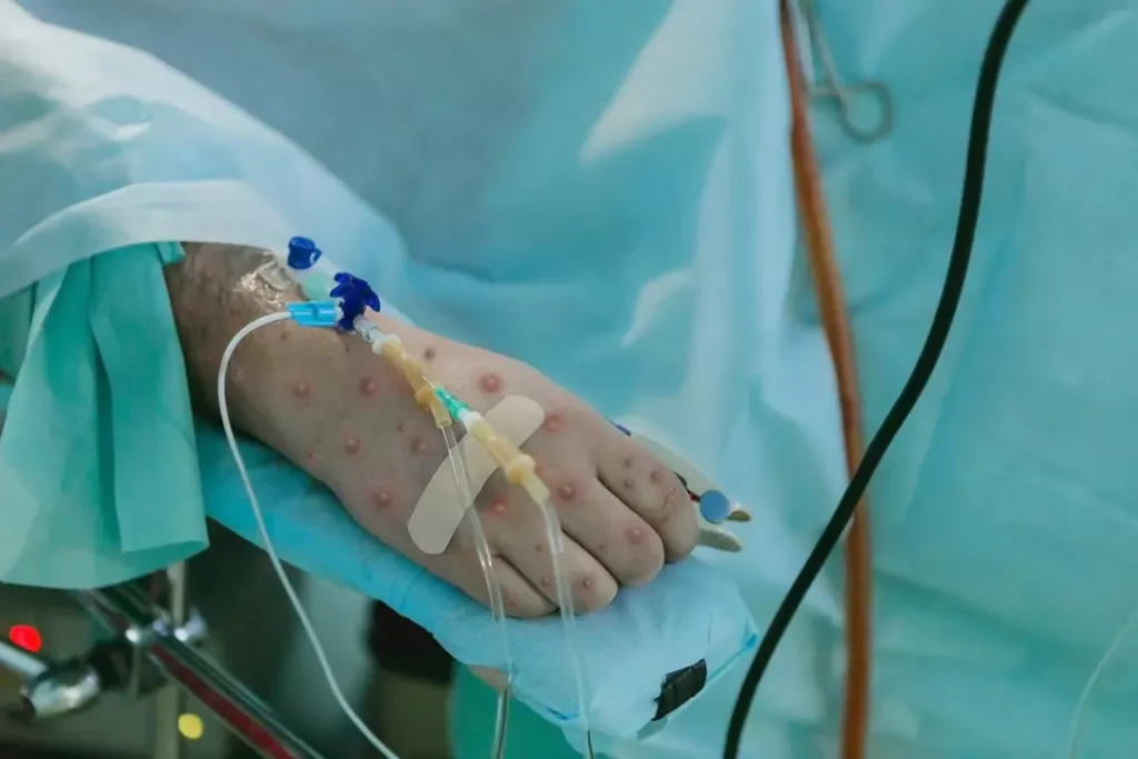 MPOX yeni varyant rekombinant