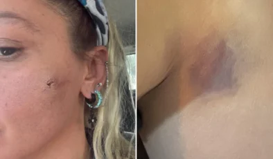 Son Dakika: Ünlü Oyuncu Yıldız Asyalı Eşinden Şiddet Gördüğünü Fotoğraflarla Duyurdu