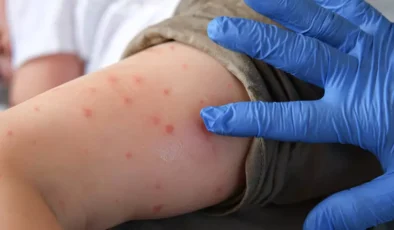 Polikliniklerde suçiçeği alarmı: Uzmanlar vakalardaki artışa dikkat çekti